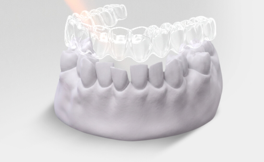 Alineador transparente ID Aligners