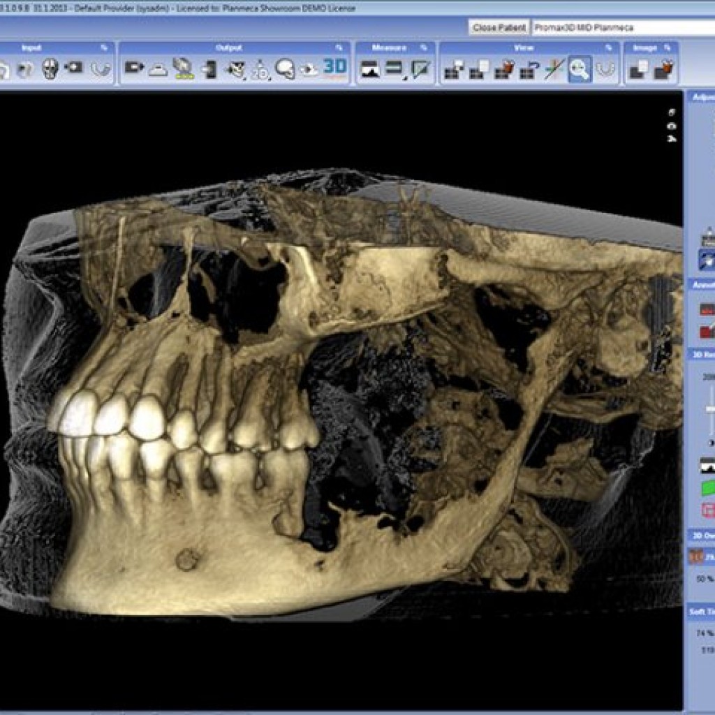 3 д снимок. Planmeca Promax 3d шум на 3д снимка. Кт челюсти на планмека. Трехмерная компьютерная томография. 3d томография зубов.